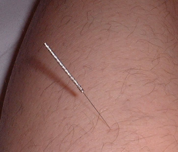 Close-up of a fine stainless steel acupuncture needle inserted into the skin of a lower leg.